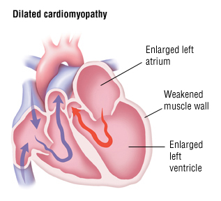 The Heart Disease DCM